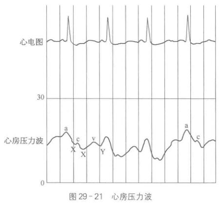 肺动脉漂浮导管监测