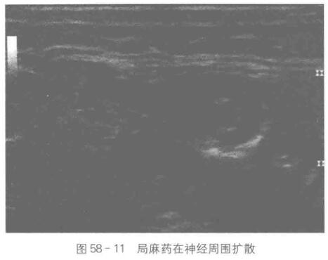 超声引导下神经阻滞