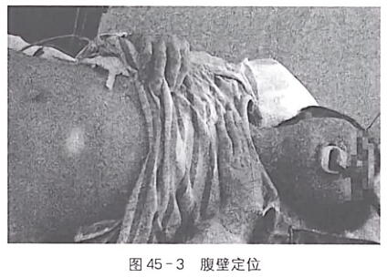 经皮穿刺胃造瘘术及空肠置管术