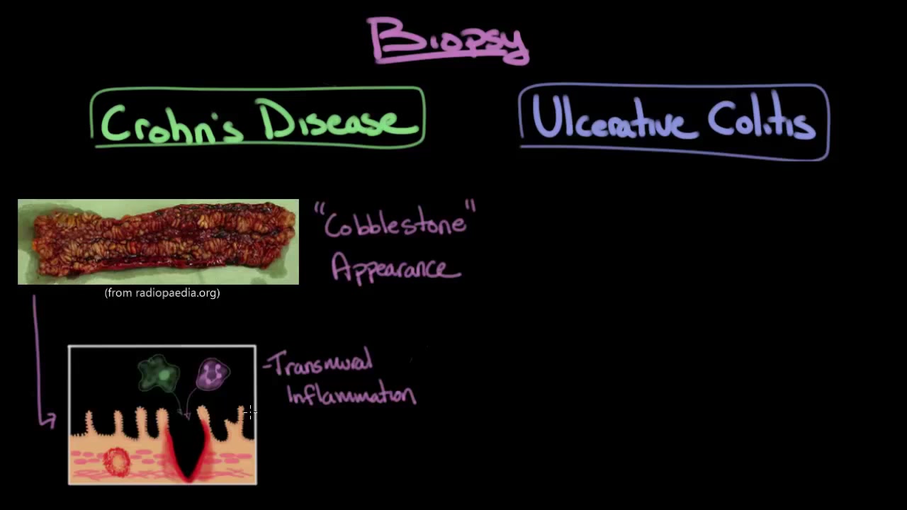 Inflammatory bowel disease-Mimosa